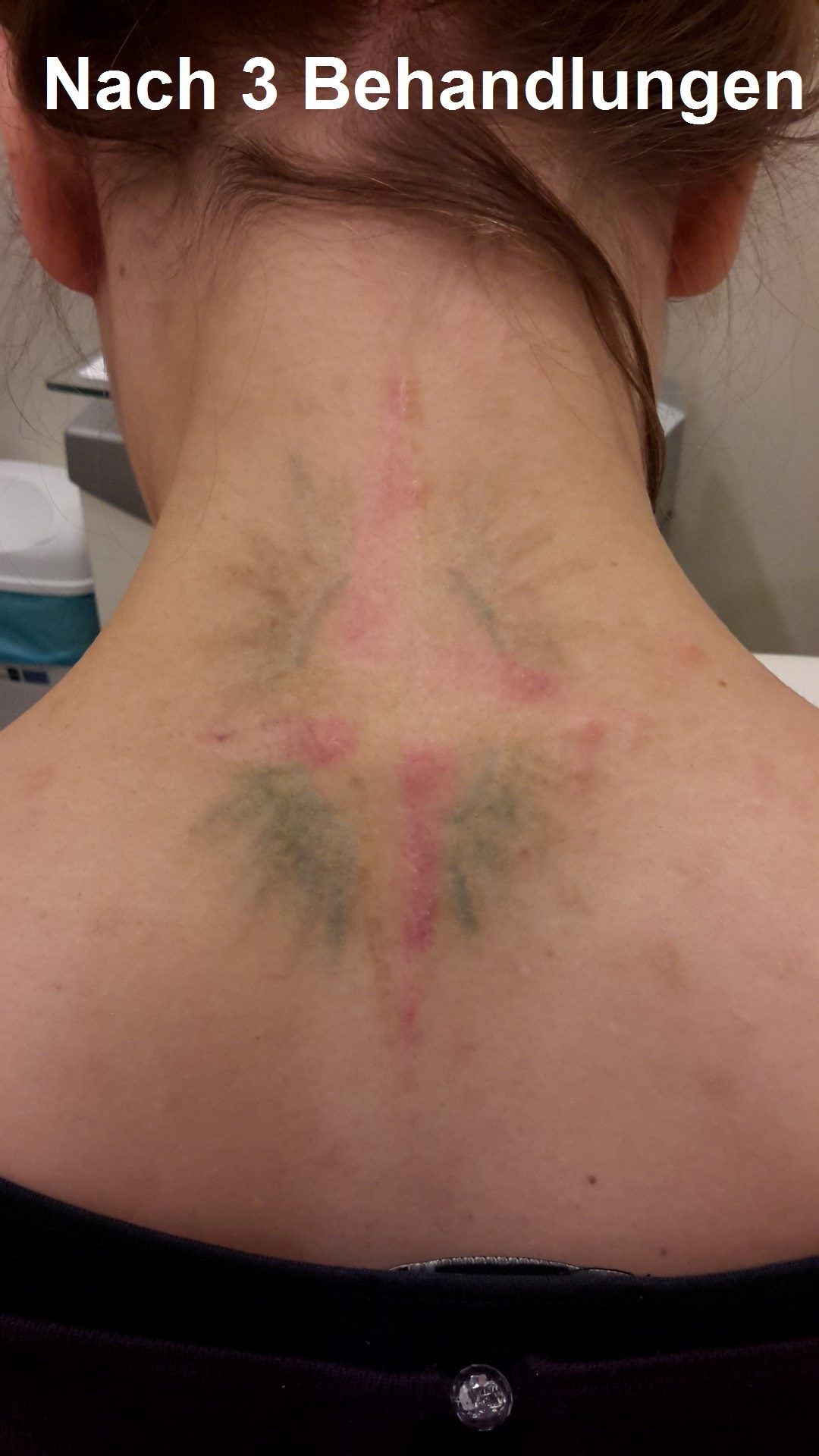 Tattooentfernung VorherNachher Bilder &amp; Kosten