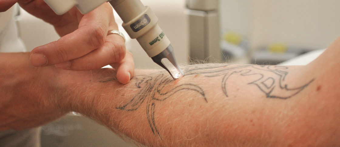 Tattooentfernung VorherNachher Bilder &amp; Kosten