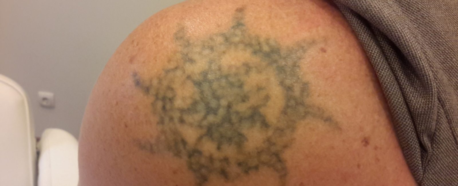 Tattoo auf Schulter Vorher/Nachher