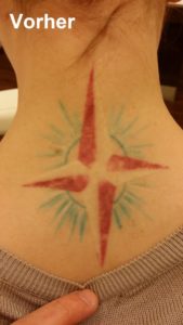Farbiges Tattoos vor der 1. Behandlung