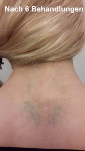 Nach 6 Behandlungen bei Dermacare (Behandlungen sind noch nicht abschlossen)