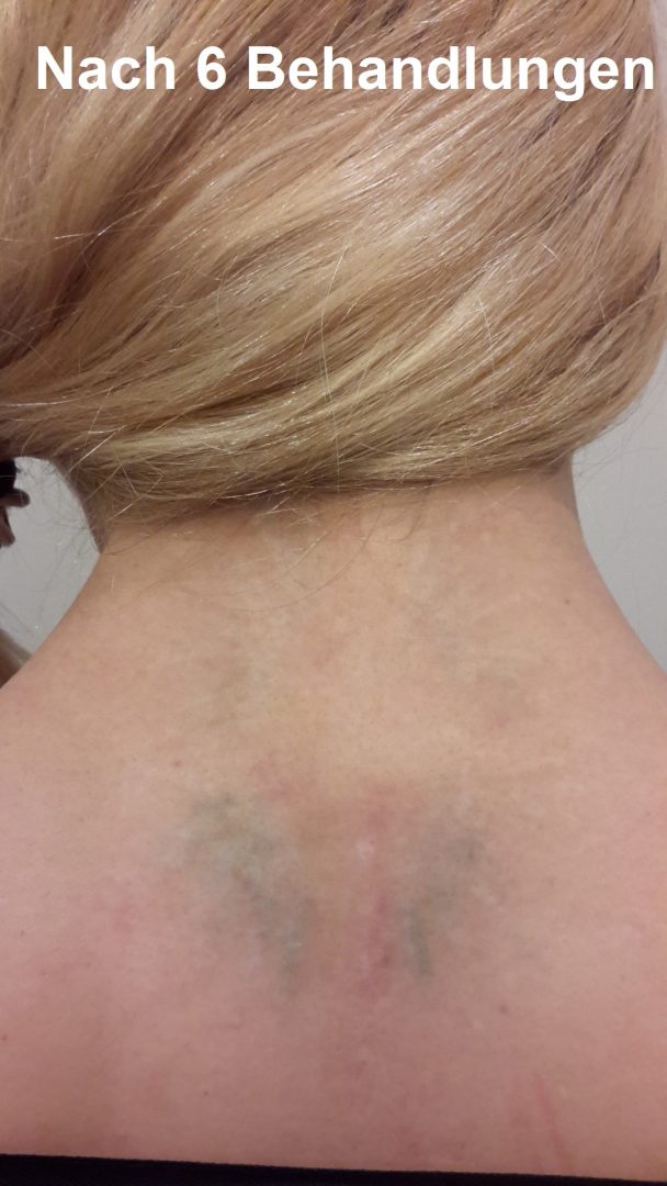 Tattooentfernung VorherNachher Bilder &amp; Kosten
