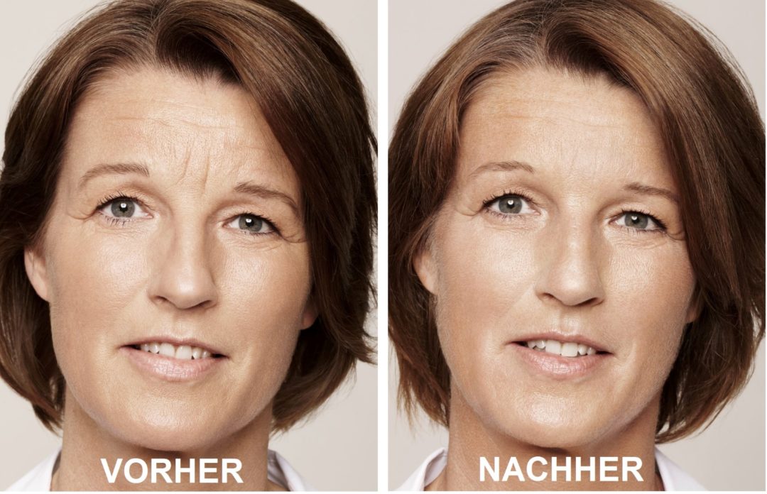 Unterspritzungen Gesicht