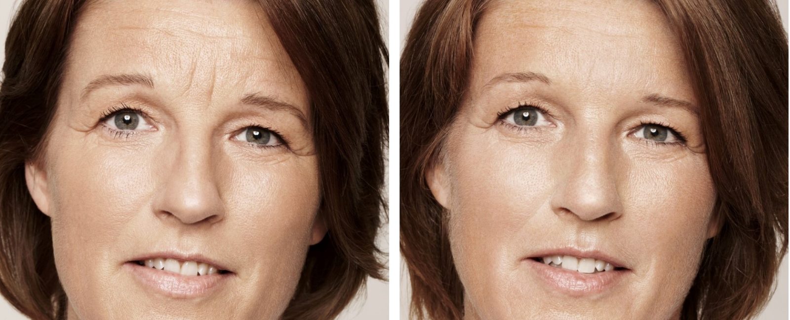 Faltenunterspritzung In Wien Mit Hyaluronsaure Von Juvederm