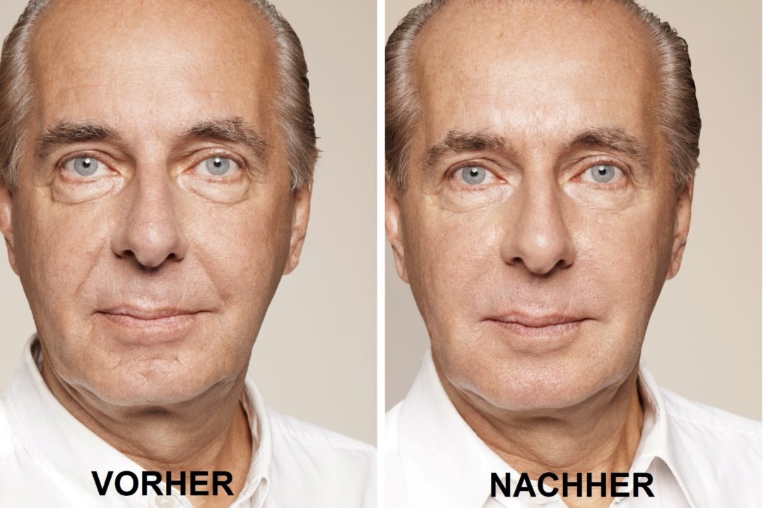 Faltenunterspritzung in Wien mit Hyaluronsäure von Juvederm