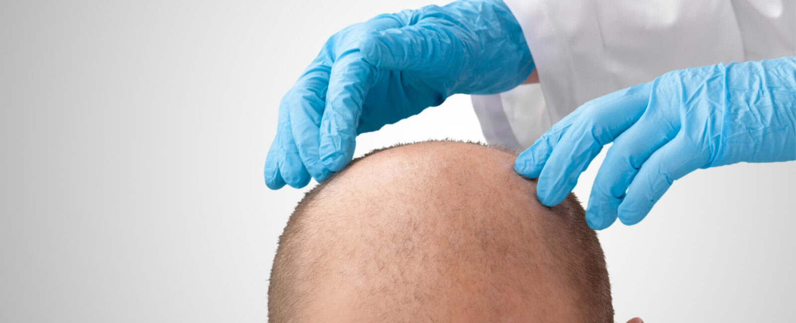 Das Bild zeigt einen Mann mit kahler Kopfhaut, der von einem Arzt mit blauen Handschuhen untersucht wird. Diese Darstellung verdeutlicht die Problematik des Haarausfalls und die Notwendigkeit von Haartransplantationen. Haarverpflanzung in Ungarn bietet eine kostengünstige und professionelle Lösung, da das Land für seine fortschrittlichen medizinischen Dienstleistungen bekannt ist.