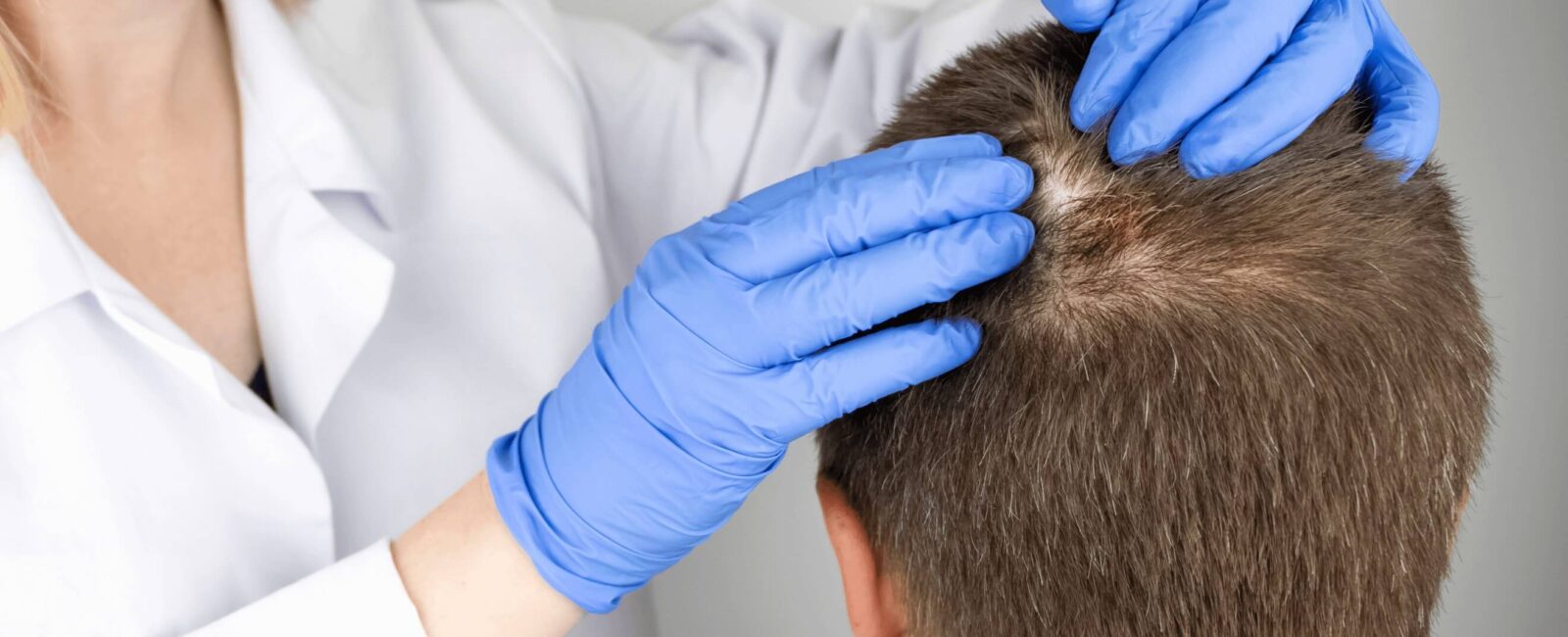 Das Bild zeigt eine Person, die von einem Mediziner in einem kosmetischen Institut untersucht wird. Der Mediziner trägt blaue Einweghandschuhe und hebt das Haar des Patienten an, um die Kopfhaut zu untersuchen. Dies deutet darauf hin, dass eine Haarverpflanzung in Wien vorbereitet oder überprüft wird. Der Fokus liegt auf dem Bereich der Kopfhaut, wo möglicherweise eine Haartransplantation durchgeführt wurde oder geplant ist. Die Szene vermittelt ein professionelles und hygienisches Umfeld, wie es für eine Haarverpflanzung bei Dermacare Wien typisch ist.
