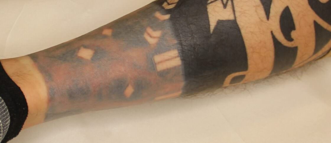 Tattooentfernung VorherNachher Bilder &amp; Kosten