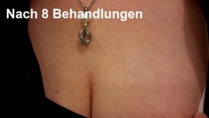 Ergebnis der Tattooentfernung nach 8 Behandlungen bei Dermacare in Wien