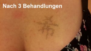 Ergebnis der Tattooentfernung nach drei Wochen bei Dermacare in Wien