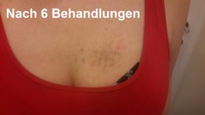 Ergebnis der Tattooentfernung nach 6 Behandlungen bei Dermacare in Wien
