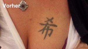 Vor der Tattooentfernung bei Dermacare in Wien