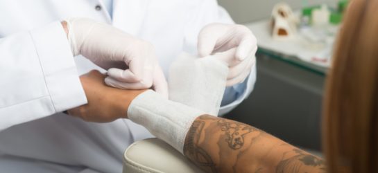 Tattooentfernung_Picolaser_1010_Wien_Dermacare