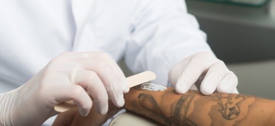 Tattooentfernung_Picolaser_1010_Wien_Dermacare