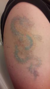 Mehrfarbiges Tattoo: Zwischenergebnis nach 2 Tattooentfernungen