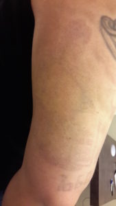 Laser-Tattooentfernung am Oberarm nach 6 Behandlungen