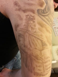 Laser-Tattooentfernung am Oberarm nach 1 Behandlung