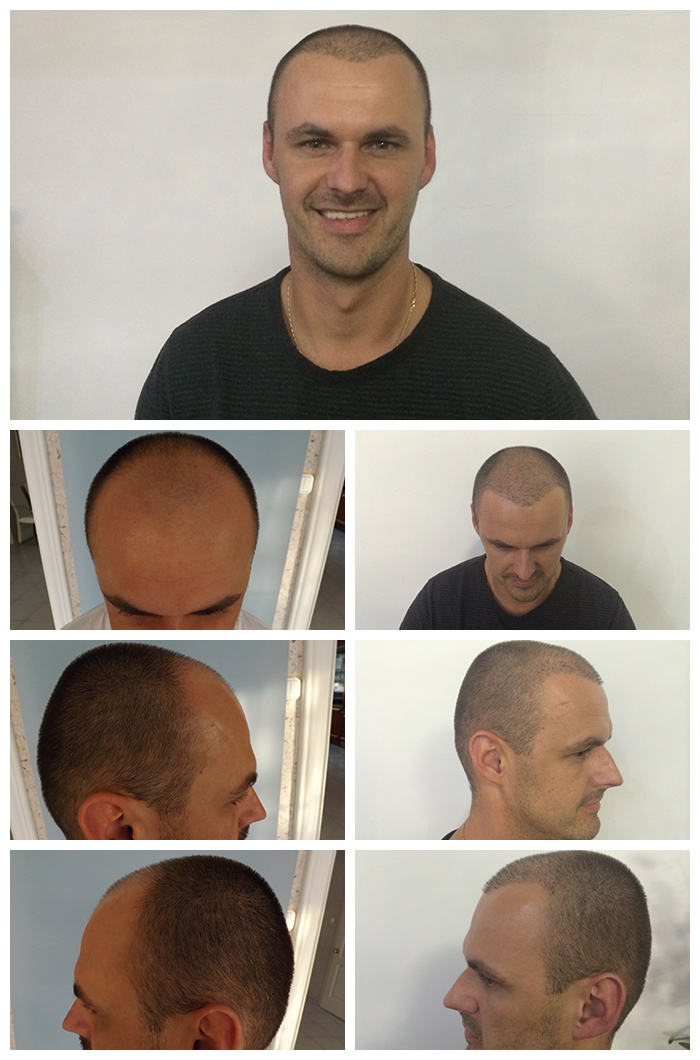 Haartransplantation In Wien Bei Dermacare