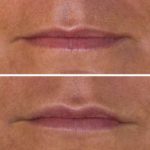 Diese Faltenunterspritzung zeigt das Gesicht einer Frau vor und nach der Hyaluronsäurebehandlung gegen Lippen- und Marionettenfalten.