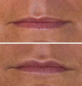 This wrinkle injection shows a woman's face before and after hyaluronic acid treatment for lip and puppet wrinkles.