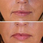 Diese Faltenunterspritzung zeigt das Gesicht einer Frau vor und nach der Hyaluronsäurebehandlung gegen Lippen- und Marionettenfalten.