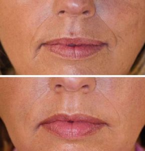 This wrinkle injection shows a woman's face before and after hyaluronic acid treatment for lip and puppet wrinkles.