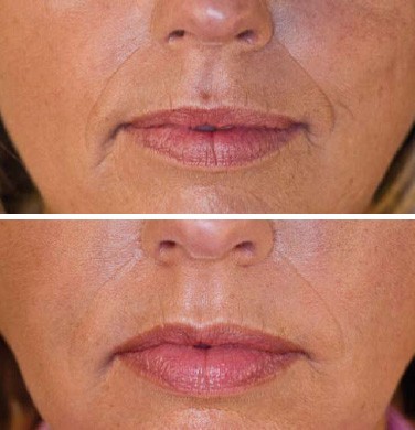 Faltenunterspritzung In Wien Mit Hyaluronsaure Von Juvederm