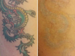 Vorher und nach 5 Behandlungen