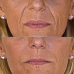 Diese Faltenunterspritzung zeigt das Gesicht einer Frau vor und nach der Hyaluronsäurebehandlung gegen Lippen- und Marionettenfalten.