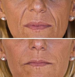 This wrinkle injection shows a woman's face before and after hyaluronic acid treatment for lip and puppet wrinkles.