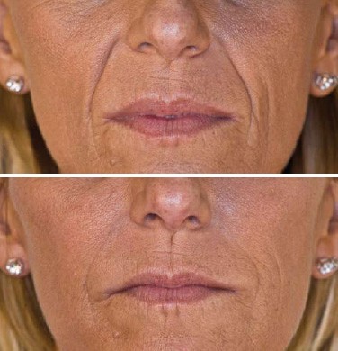 Faltenunterspritzung In Wien Mit Hyaluronsaure Von Juvederm