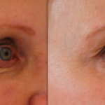 Bei dieser Dame wurden sowohl Botox als auch ein Hyaluronfiller eingesetzt