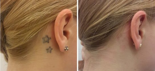 Tattoo hinter dem Ohr vollständig verschwunden