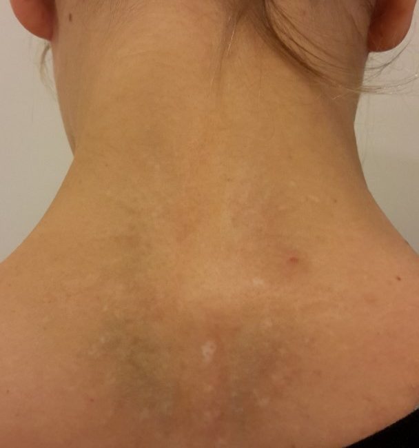 Tattoo Removal Vienna With Laser