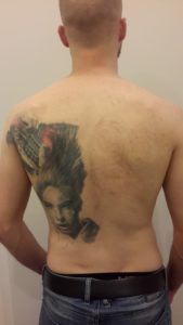 Tattoo Removal Vienna With Laser