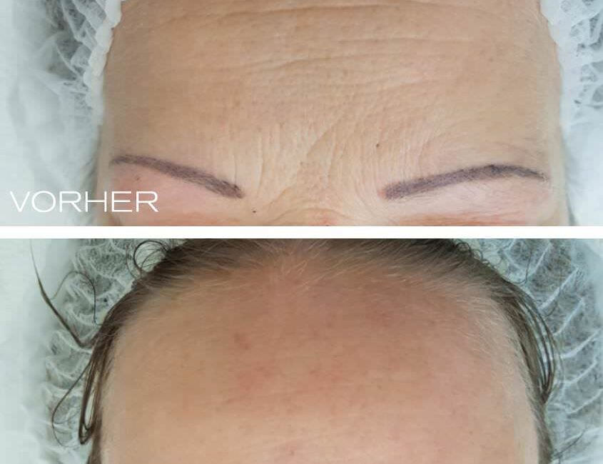 Pqage Peeling Sofort Lifting Wow Effekt Bei Dermacare In 1010 Wien