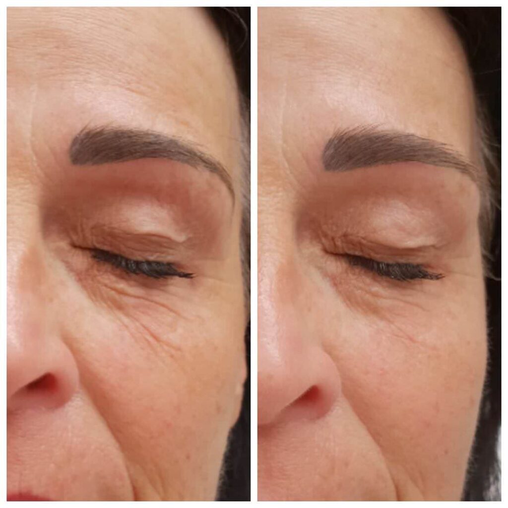 Pqage Peeling Instant Lifting Wow Effect At Dermacare Vienna