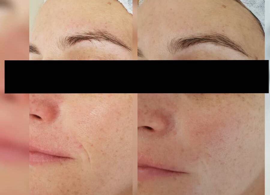 Pqage Peeling Sofort Lifting Wow Effekt Bei Dermacare In 1010 Wien