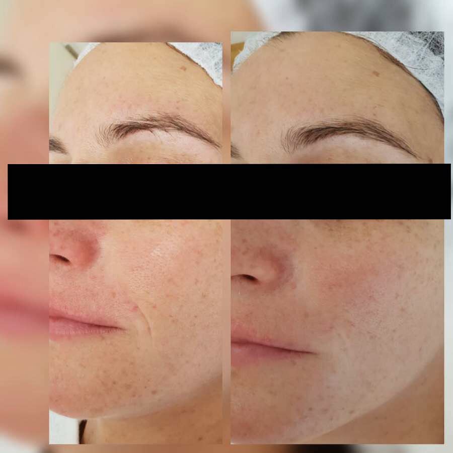 PQAge Peeling SofortLiftingWowEffekt Bei Dermacare