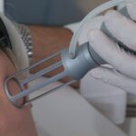Aknenarben entfernen mit Laser bei Dermacare