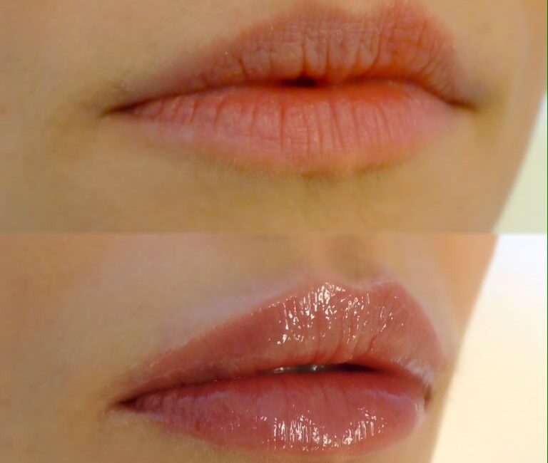 Lippen Aufspritzen Wien Lippenkorrektur Fur Volle Lippen