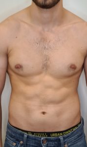 2 Wochen nach 4. Behandlung