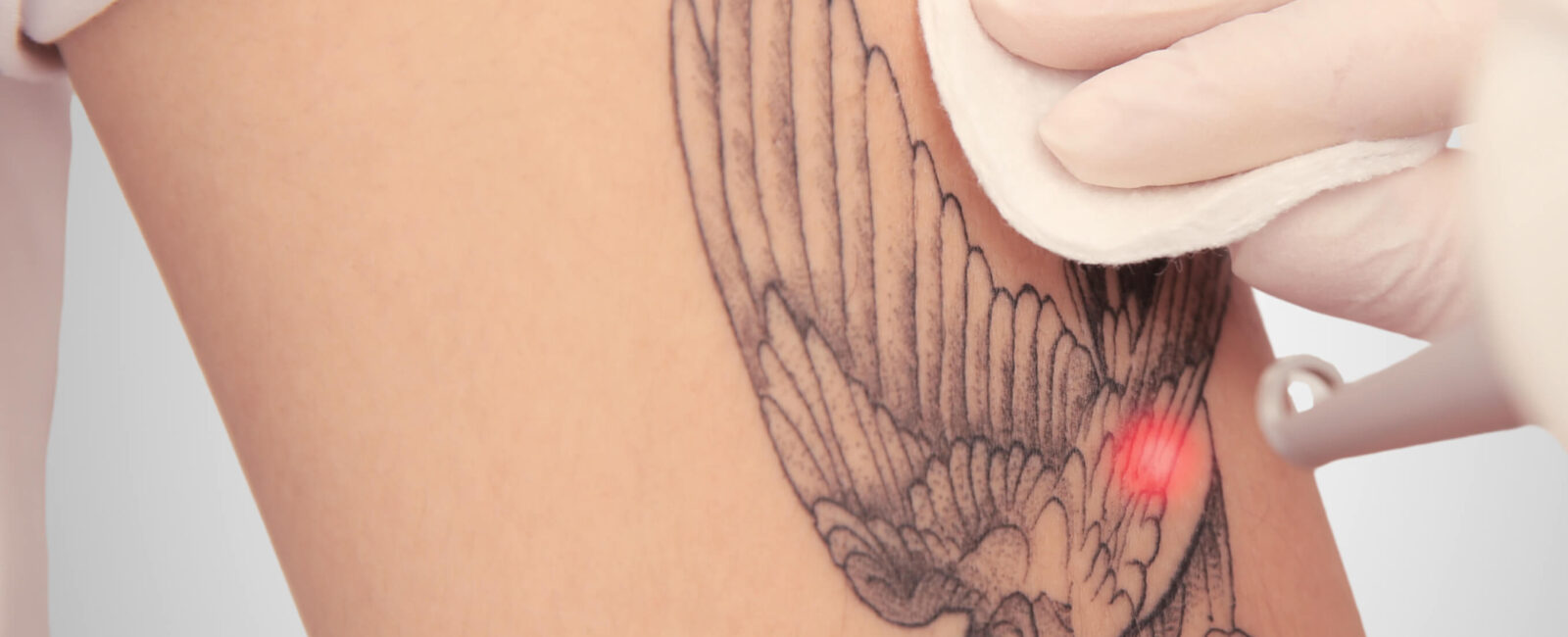 Dieses Bild zeigt den Vorgang einer Laseraufhellung auf einem schwarzen Tattoo am Arm. Ein Tätowierer bei Dermacare Wien verwendet den Laser, um die dunklen Linien und Flächen des Tattoos aufzuhellen. Diese Behandlung ist eine wichtige Vorbereitung für ein neues Cover Up Tattoo in Schwarz, da das alte Motiv durch die Aufhellung reduziert wird und Platz für eine kreativere und detaillierte Überarbeitung schafft.