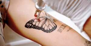 Das Bild zeigt eine Cover up Tattoo Vorbereitung, bei der ein bestehendes Tattoo mit einem Laser behandelt wird. Man sieht, wie der Laserstrahl präzise auf ein Schmetterlingsmotiv gerichtet ist, um das Tattoo aufzuhellen. Dieser Schritt ist wichtig, um die Farben und Linien des alten Tattoos zu verblassen, damit ein neues Motiv darüber gestochen werden kann. Durch die Aufhellung werden dunkle und kräftige Farben des ursprünglichen Tattoos gemildert, was mehr Spielraum für das Design des neuen Cover-ups bietet. Diese Methode sorgt für ein gleichmäßigeres und ästhetisch ansprechenderes Endergebnis beim Cover-up Tattoo.