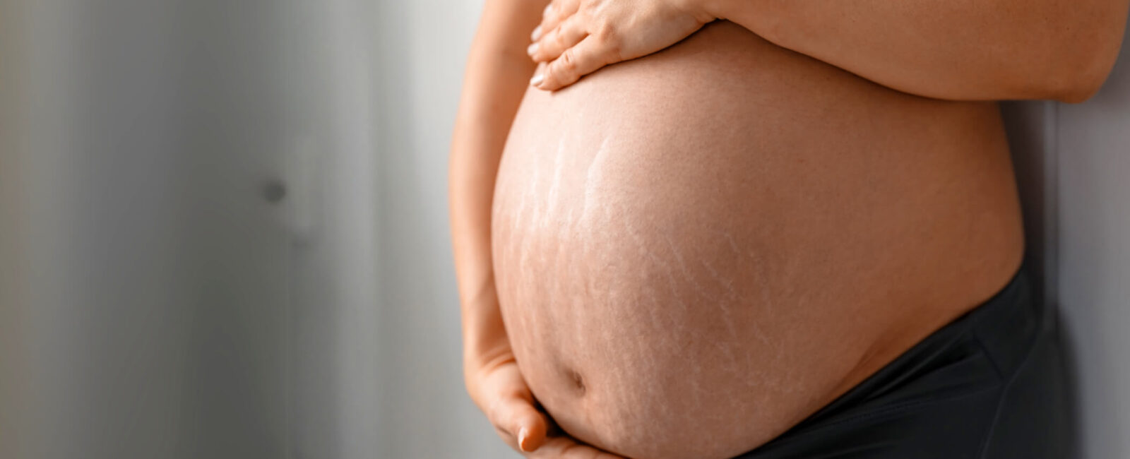 Auf dem Bild sieht man den Bauch einer schwangeren Frau, der deutlich sichtbare Schwangerschaftsstreifen am Bauch zeigt. Die feinen, hellen Linien sind typische Dehnungsstreifen durch Schwangerschaft, die durch das schnelle Dehnen der Haut entstehen. Viele Frauen wünschen sich nach der Geburt, diese Schwangerschaftsstreifen entfernen zu lassen – etwa durch moderne Behandlungen bei Dermacare in Wien.