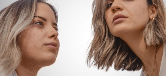 Hilft Radiofrequenz Microneedling bei Akne auf dem Bild sieht man zwei frauen die Probleme mit ihrer haut haben. Es sind Aknenarben sichtbar. jetzt wenden sie sich an Dermacare für Microneedling bei Akne.