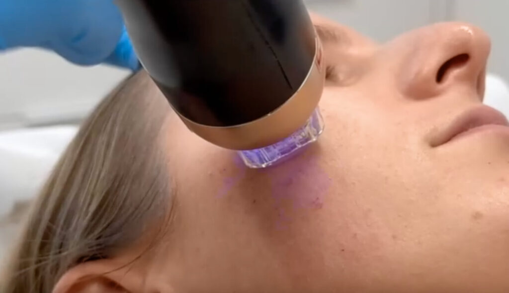 Auf diesem Bild sieht man eine Frau bei der gerade Radiofrequenz Microneedling bei Akne angewendet wird. Man sieht das Gerät mit blauem Licht nah auf der Haut.