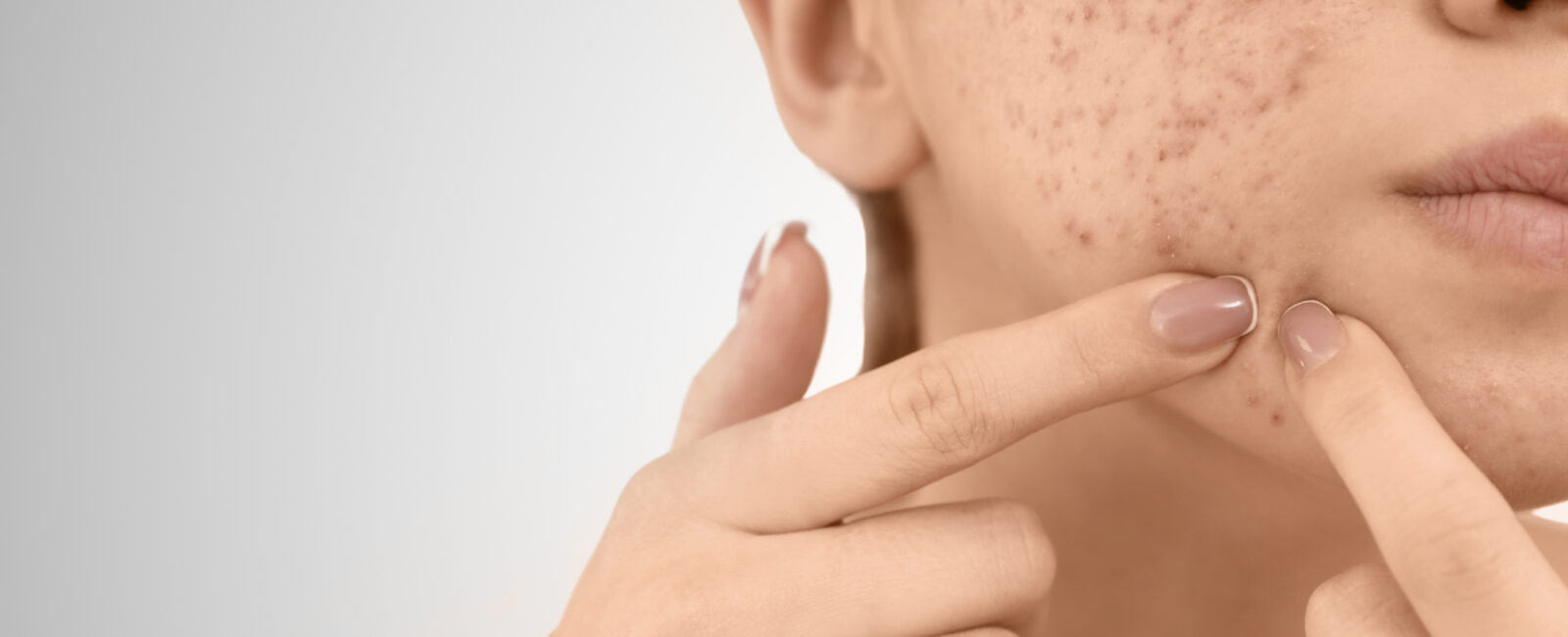 Auf dem Bild sieht man ein Mädchen dass ihre Pickelmale entfernen möchte. Sie fragt sich bestimmt was sind Pickelmale eigentlich genau? Bei dermacar wien können wir uns solche Patient:innen genauer anschauen.