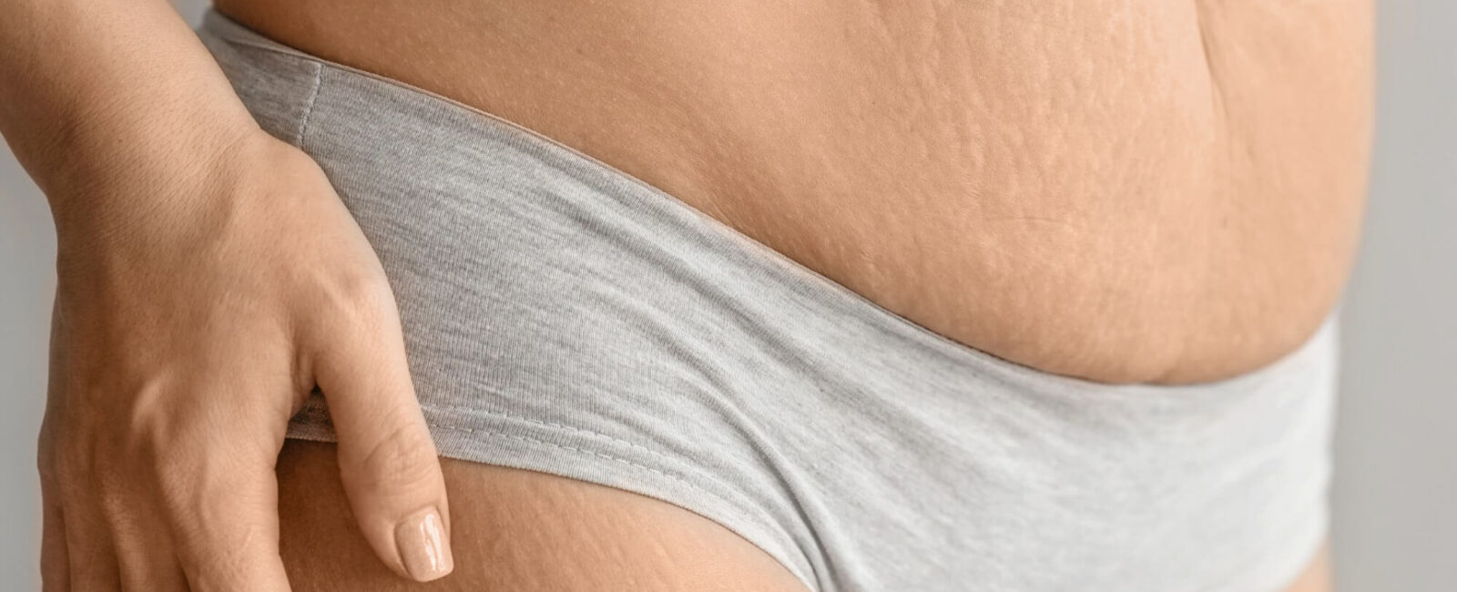 Auf dem Bild ist der Körper einer Frau zu sehen. Sie leidet sehr unter Dehnungsstreifen, womglich von der Schwangerschaft. Dermacare hat unzählige Behandlungen die gegen Dehnungsstreifen wirksam sind.