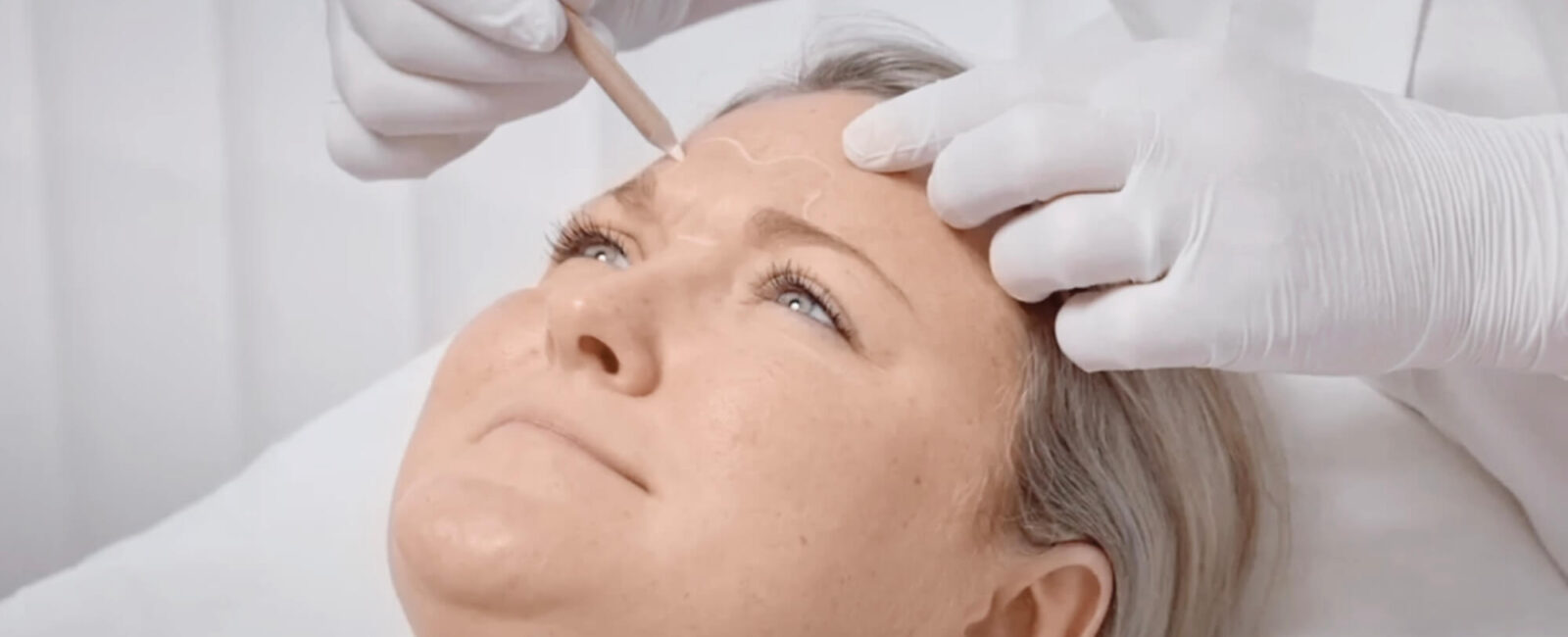 Was kostet Botox für die Stirn? Das Bild zeigt eine Frau deren Stirn gerade mit einem weißen Stift für die anschließende Behandlung markiert wird. Bevor sie zur Behandlung ging wurde sie zudem ausführlich über die Behandlung aufgeklärt und die Botox Kosten für Stirn. Finden auch Sie eine Behandlung mit Botox in der Nähe.